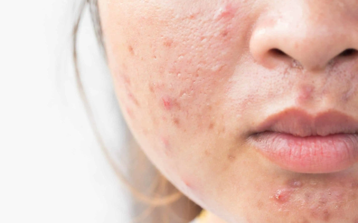 Cách Hiệu Quả Để Ngăn Ngừa Mụn Trứng Cá Trong Thời Kỳ Kinh Nguyệt