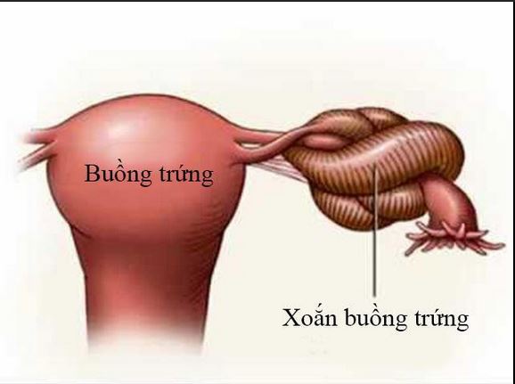Khám Phá Nguyên Nhân và Triệu Chứng Của Xoắn U Nang Buồng Trứng