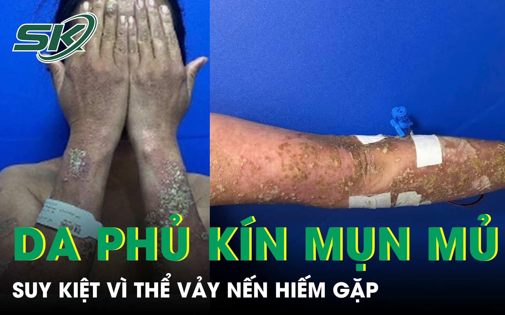 Cảnh Giác Về Những Tổn Thương Da Nặng Vì Tự Ý Bôi Thuốc Chữa Vảy Nến