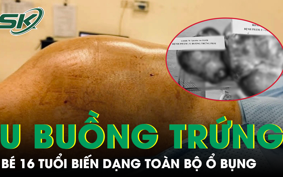Cảnh Giác Về Khối U Buồng Trứng Ở Trẻ Em: Dấu Hiệu Nhận Biết Và Nguy Cơ