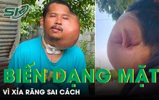Khám Phá Hiện Tượng Sụp Mí: Nguyên Nhân và Giải Pháp