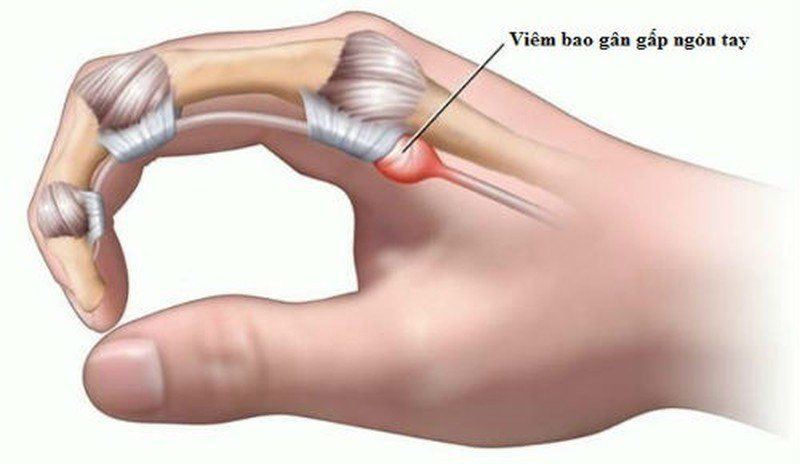 Cảnh Giác Với Viêm Gân Gấp Ngón Tay: Dấu Hiệu và Phương Pháp Điều Trị