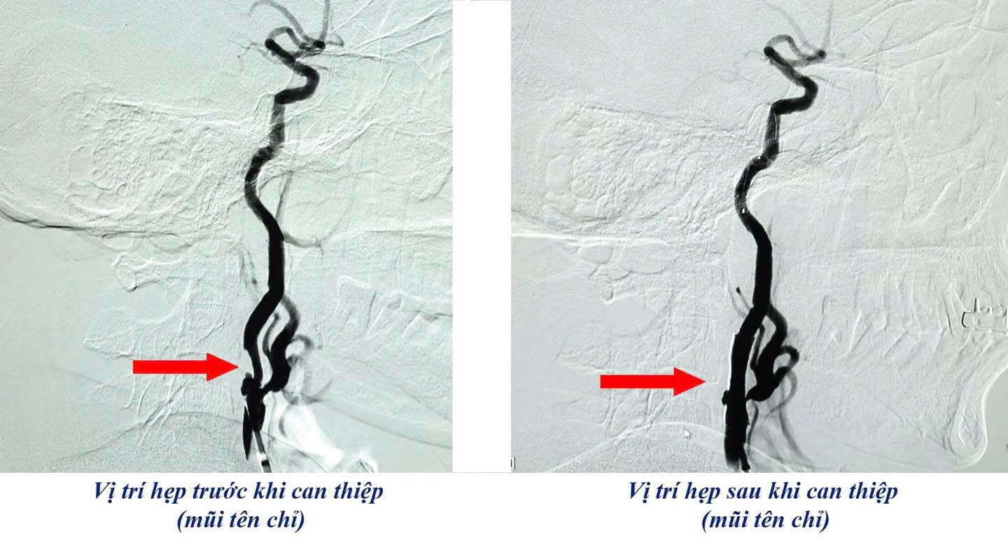 Giải pháp can thiệp nội mạch cho người cao tuổi- Ảnh 2.