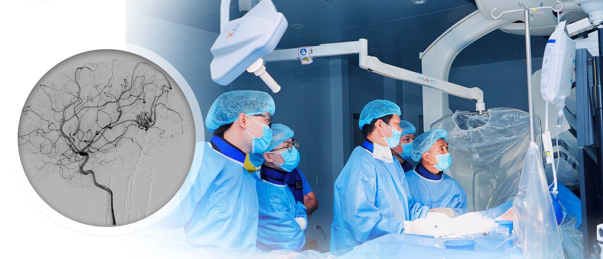 Can Thiệp Nội Mạch: Cuộc Chiến Chống Dị Dạng Mạch Máu Não Ở Trẻ Em