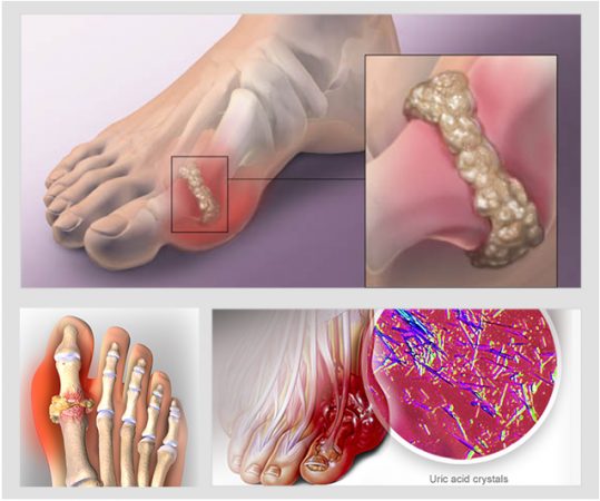 Mối Liên Hệ Giữa Tăng Acid Uric và Sức Khỏe Tình Dục Nam Giới