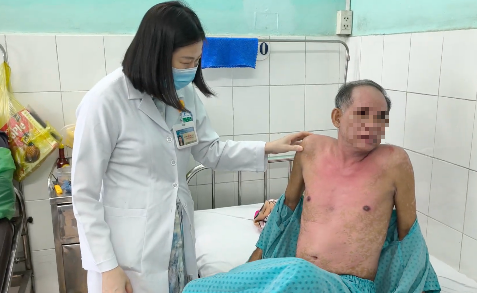 Nguy Cơ Từ Dị Ứng Thuốc Nhỏ Mắt: Một Tình Huống Nguy Kịch Cần Quan Tâm