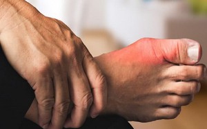 Chạy Bộ An Toàn Cho Người Bệnh Gout: Hướng Dẫn và Lời Khuyên