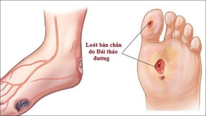 Cảnh Báo Biến Chứng Thần Kinh Ở Người Bệnh Tiểu Đường