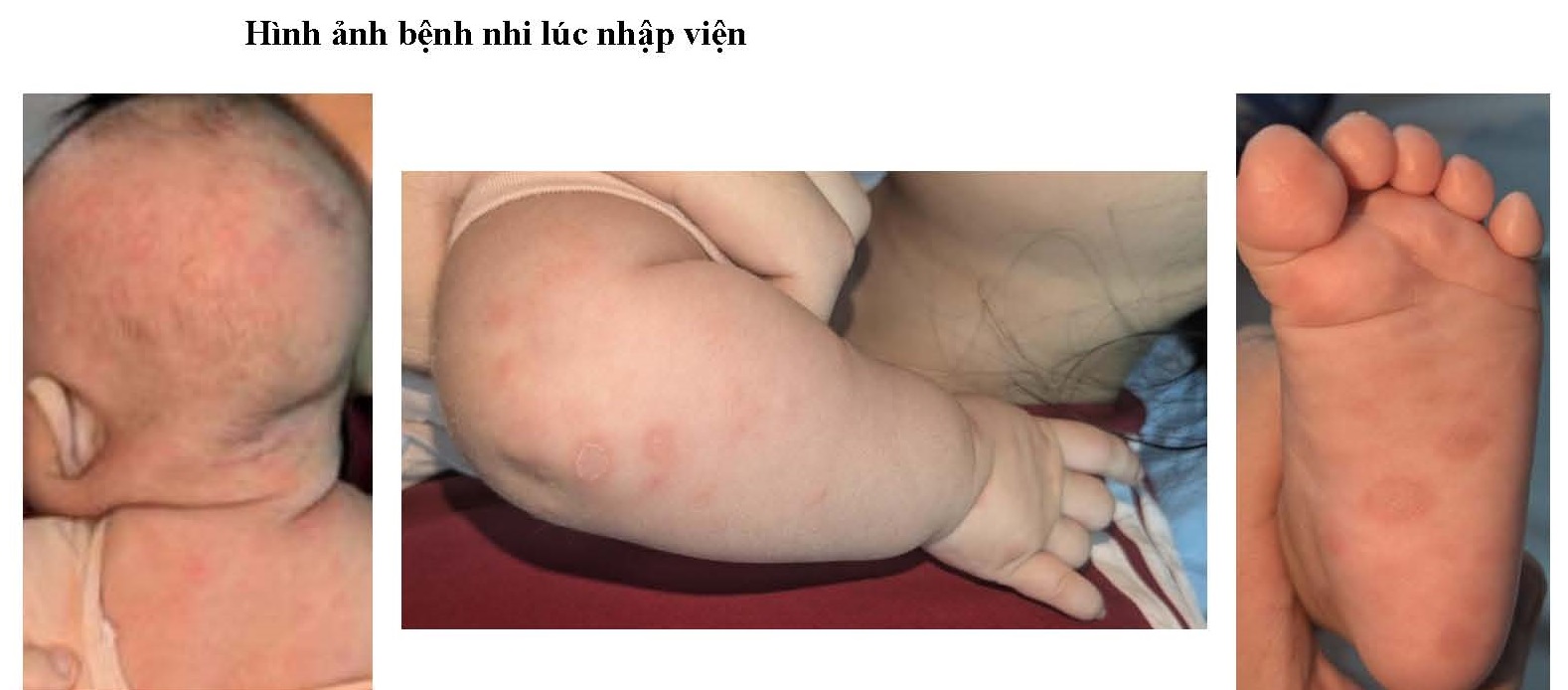 hinh-anh-tre-mac-giang-mai-bam-sinh-17869593503091243514914 Bé gái 2 tháng tuổi mắc giang mai bẩm sinh - Ảnh 1.