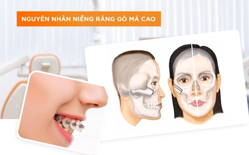 Giải Quyết Vấn Đề Hóp Má Khi Niềng Răng: Nguyên Nhân và Phương Pháp Khắc Phục