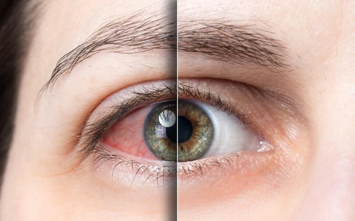 Khô mắt: Nguyên nhân và triệu chứng