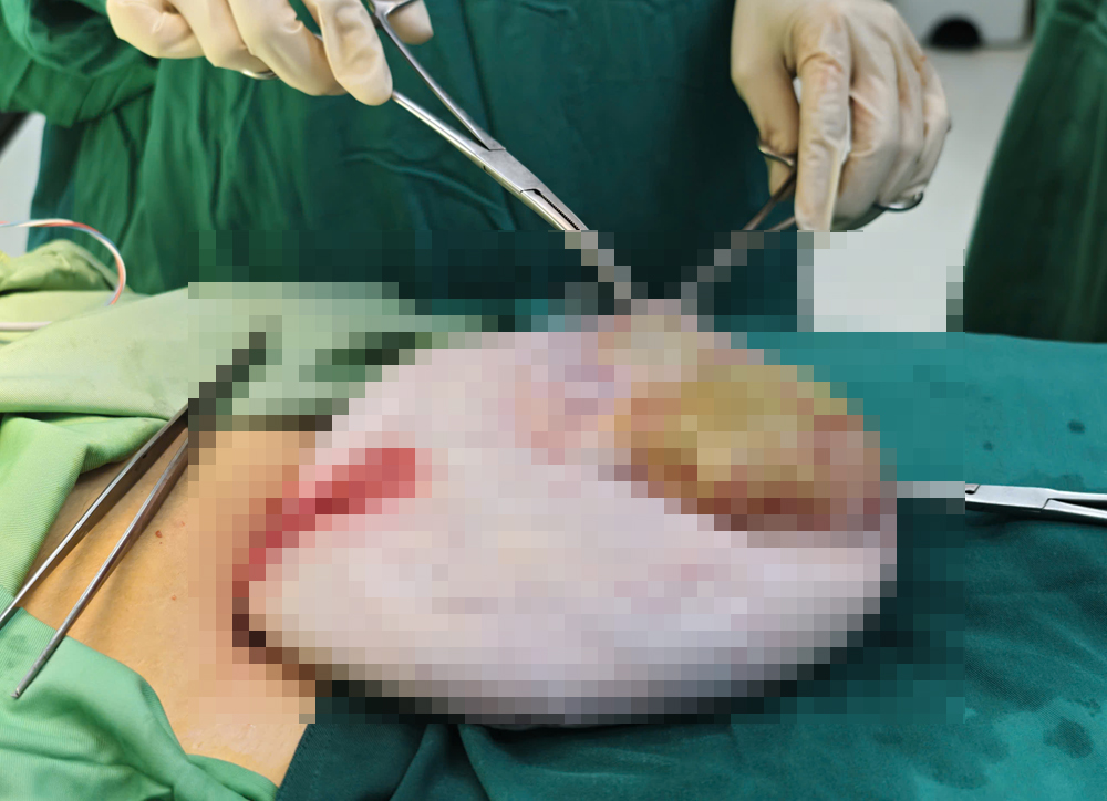 Bé gái 15 tuổi có khối u buồng trứng gần 30 cm, chứa 6 lít dịch - Ảnh 4.
