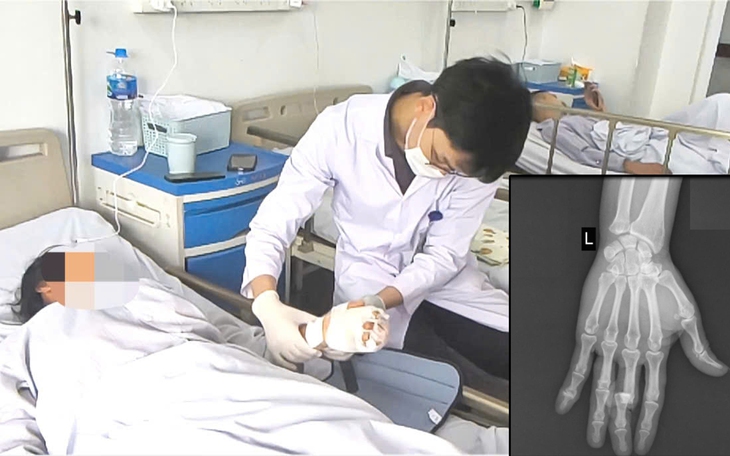 Vi phẫu cứu ngón tay đứt lìa cho nữ công nhân.
