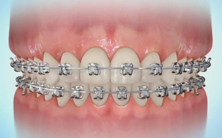 Niềng răng bị hóp má: Nguyên nhân và cách khắc phục hiệu quả- Ảnh 1.