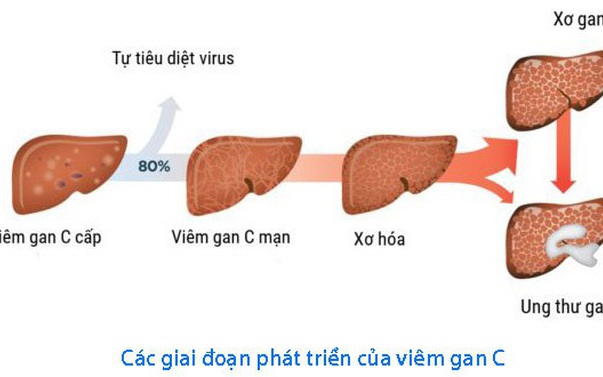 Chống Đỡ Gánh Nặng Viêm Gan: Hướng Tới Mục Tiêu 2030