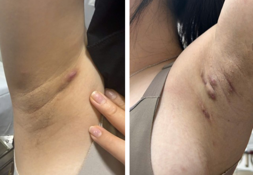 Viêm tuyến mồ hôi mủ thường bị nhầm với mụn trứng cá, viêm nang lông - Ảnh 1.