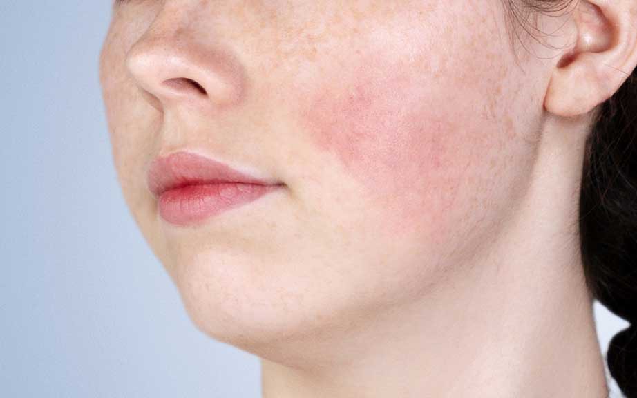 Những Lợi Ích Của Retinol Đối Với Vùng Da Mắt: Cách Sử Dụng Hiệu Quả