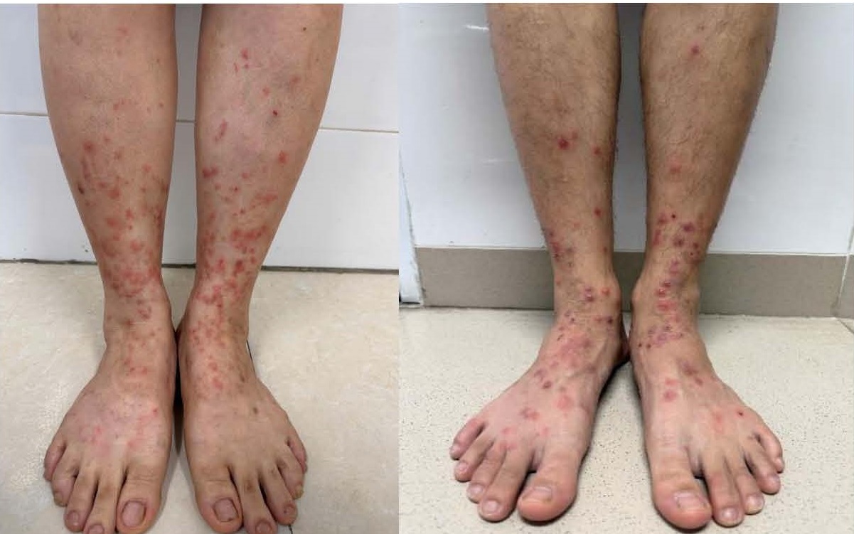 Cần làm gì khi nghi ngờ bị viêm da tiếp xúc?- Ảnh 2.