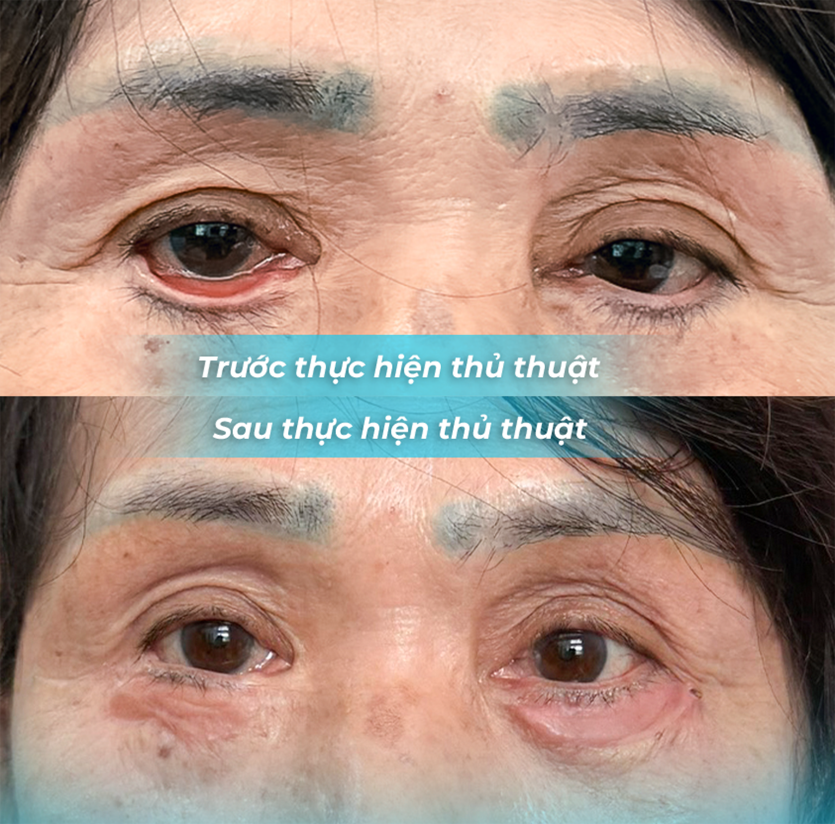 Những Rủi Ro Khi Thực Hiện Phẫu Thuật Thẩm Mỹ: Câu Chuyện Cảnh Tỉnh