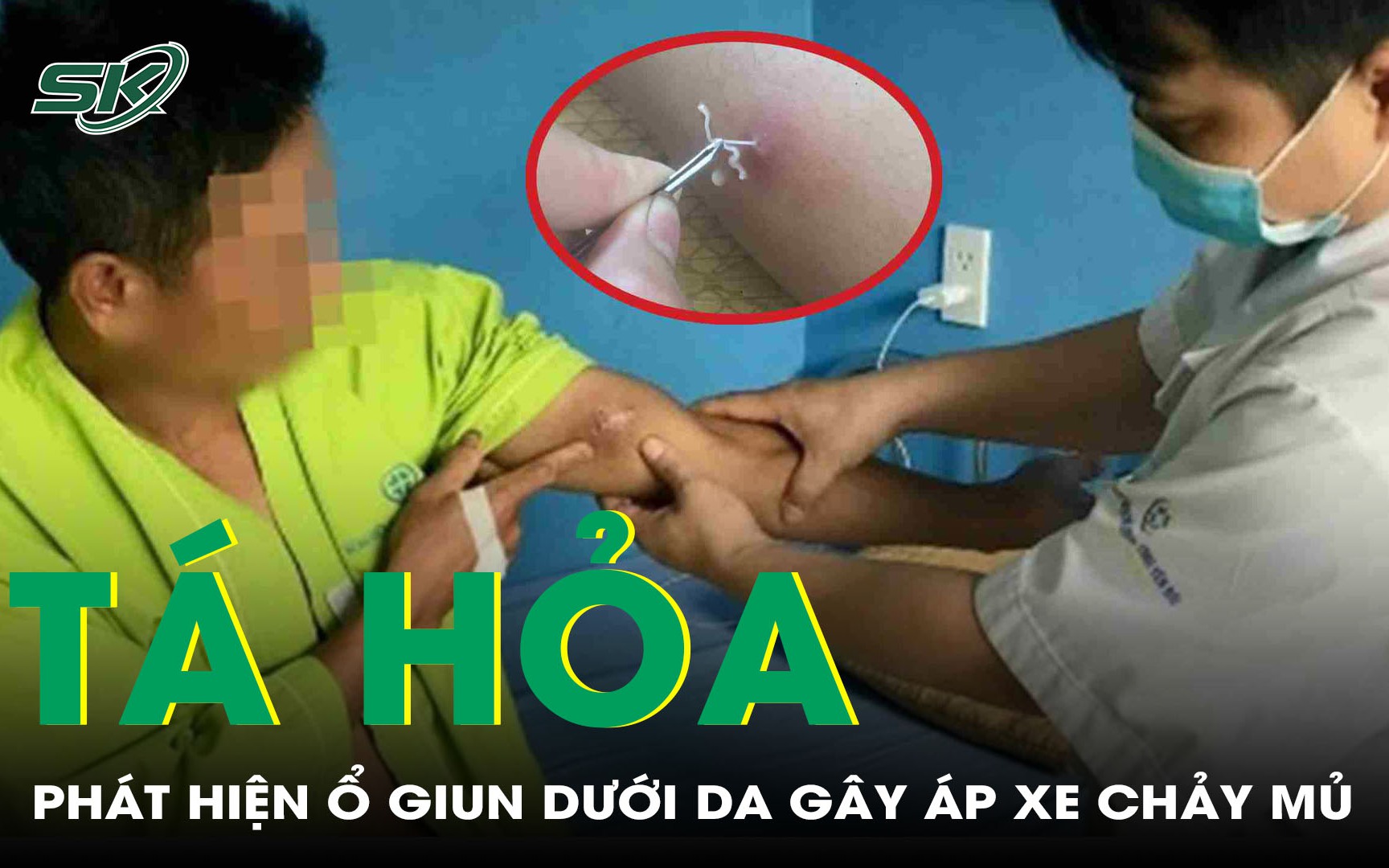 Phát Hiện Ca Mắc Giun Rồng Thứ 44 Tại Việt Nam: Điều Cần Biết