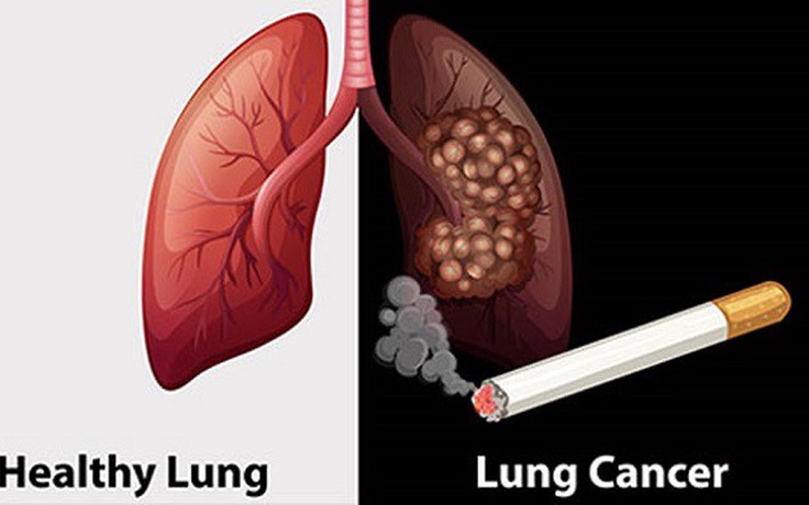Chẩn Đoán Sớm Ung Thư Phổi: Tại Sao Là Điều Cần Thiết?