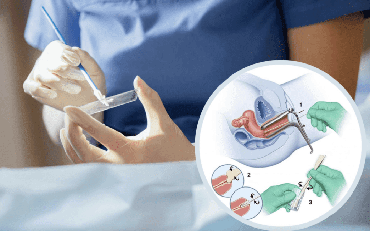 Các xét nghiệm đầu tiên giúp phát hiện sớm ung thư cổ tử cung - Ảnh 2.