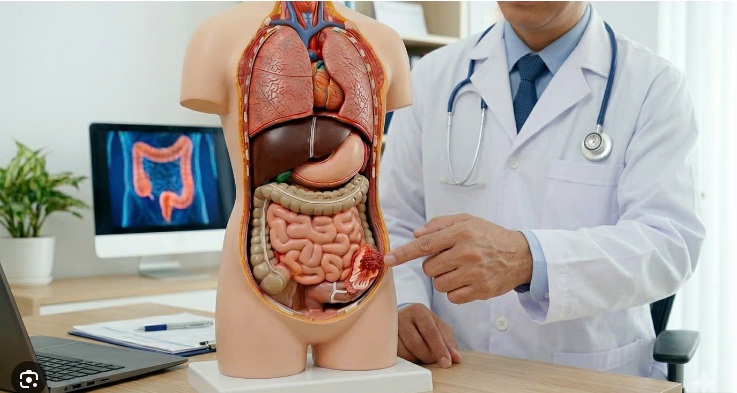 Ung thư đại tràng sống được bao lâu? Phát hiện sớm quyết định tiên lượng - Ảnh 2.