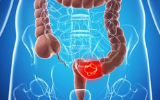 Giải Pháp Hiệu Quả Cho Vấn Đề Bí Tiểu Ở Người Cao Tuổi