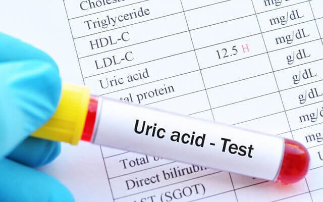 Hình ảnh minh họa cho người bị tăng acid uric