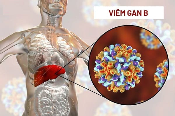 viem-gan-b-la-gi-12102022-1785553341917-17855533423511673730545 Viêm gan B cần kiêng gì để phòng biến chứng?- Ảnh 1.