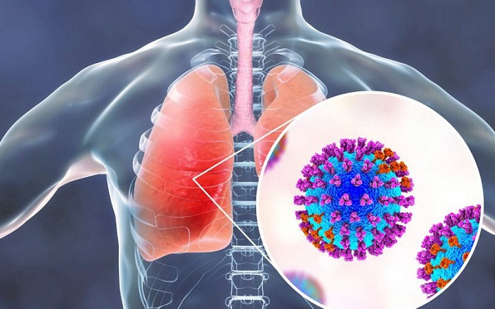Cảnh Giác Với Viêm Phổi Do Adenovirus: Dấu Hiệu và Biến Chứng Nguy Hiểm