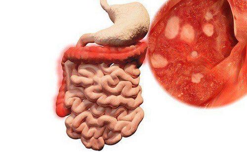 Mối Nguy Hiểm Của Viêm Ruột và Cách Phòng Ngừa Hiệu Quả