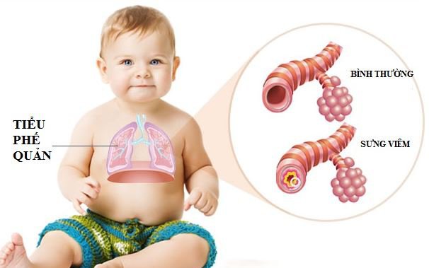 Nhận Diện Và Quản Lý Viêm Tiểu Phế Quản Cấp Ở Trẻ Nhỏ
