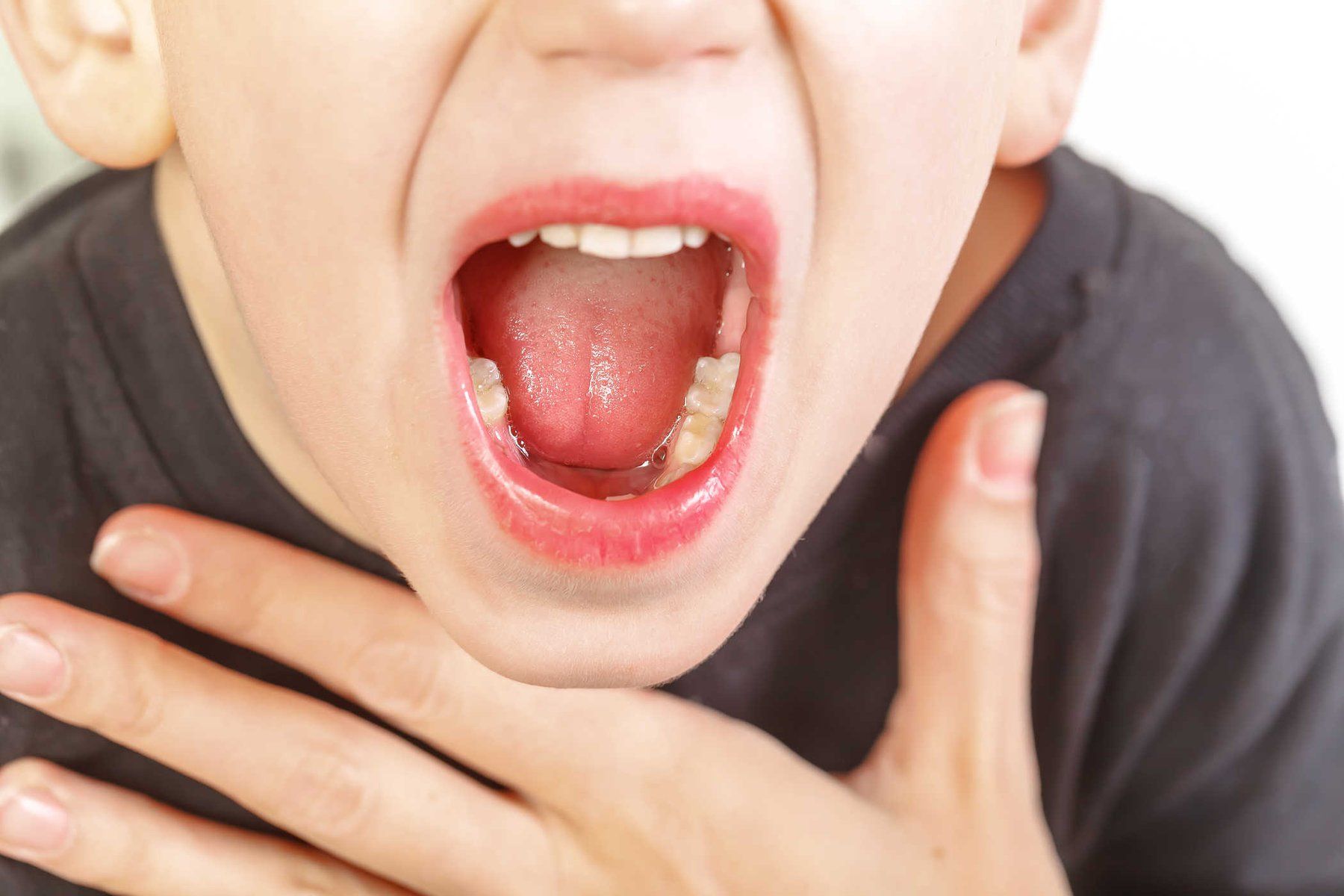 Nhận Biết Triệu Chứng Viêm VA Ở Trẻ: Cấp Tính Và Mạn Tính