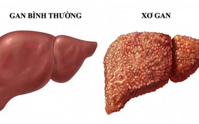 7 Dấu Hiệu Cần Chú Ý Về Tổn Thương Gan