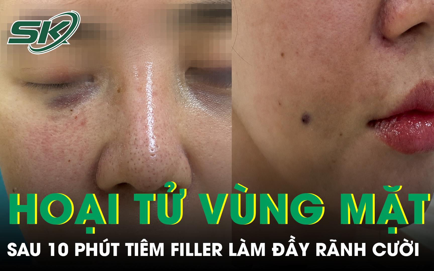 Cảnh Báo Nguy Cơ Từ Việc Tiêm Filler Vùng Ngực: Lời Khuyên Từ Chuyên Gia