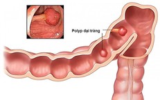 Nhận diện và giảm thiểu 4 nguy cơ chính dẫn đến Alzheimer