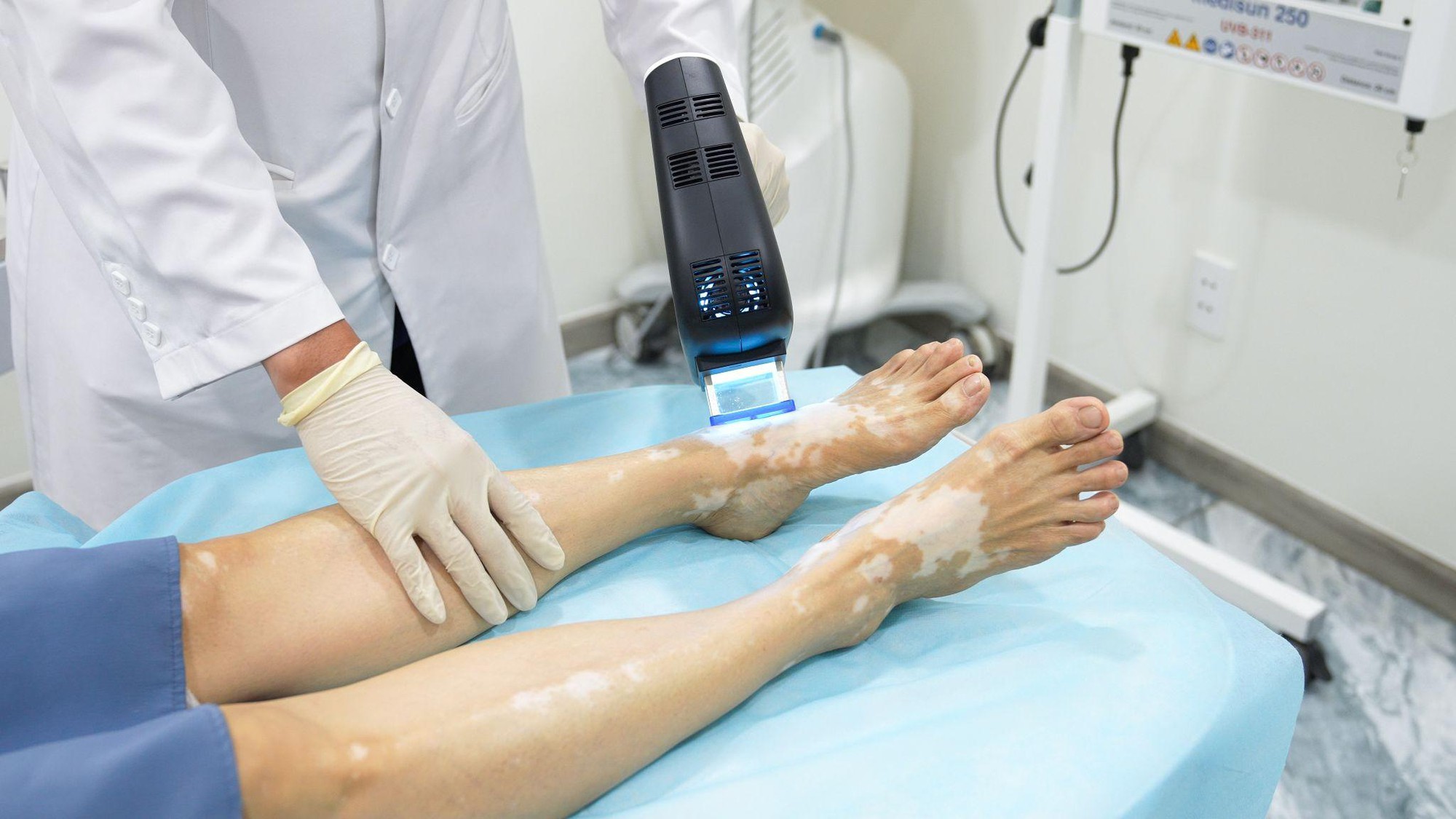 Excimer 308nm: Liệu pháp tia tập trung cho bạch biến và những điều cần biết